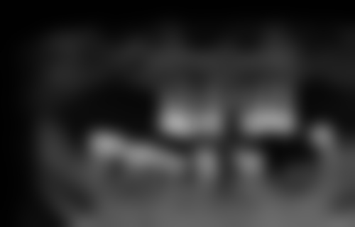 一口牙全部换掉多少钱：活动假牙2000元起，种植牙5万 - 30万不等 