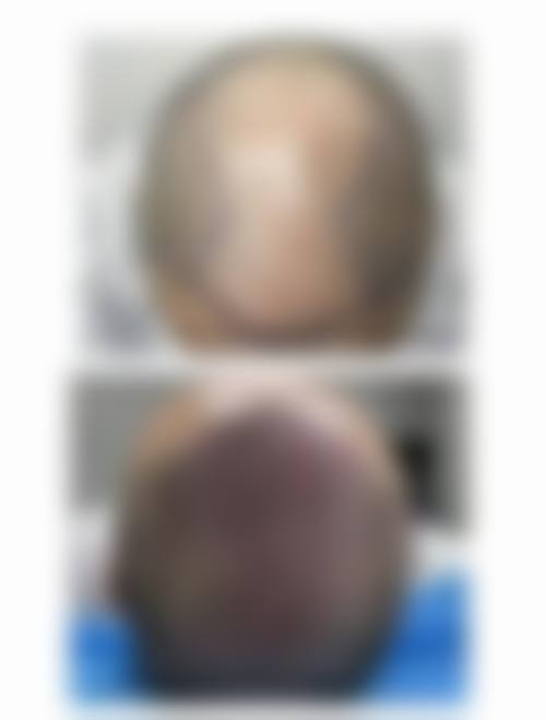 惠州麦穗植发医院价格参考