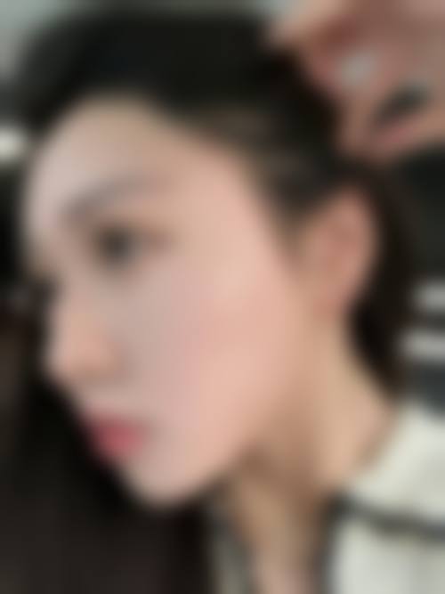 惠州麦穗植发医院患者反馈