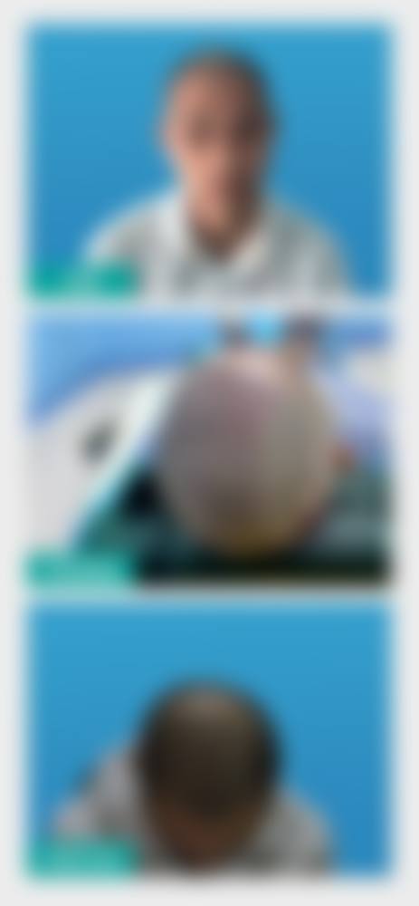 龙岩毛大夫植发门诊部患者反馈