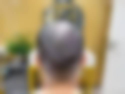 西安伊美尔加禾植发医院患者评价