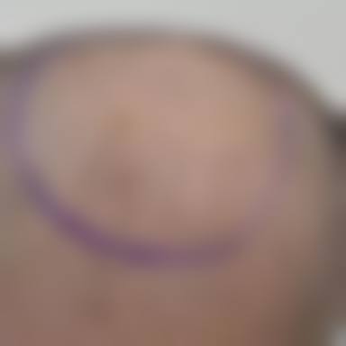 西安伊美尔加禾植发医院核心项目