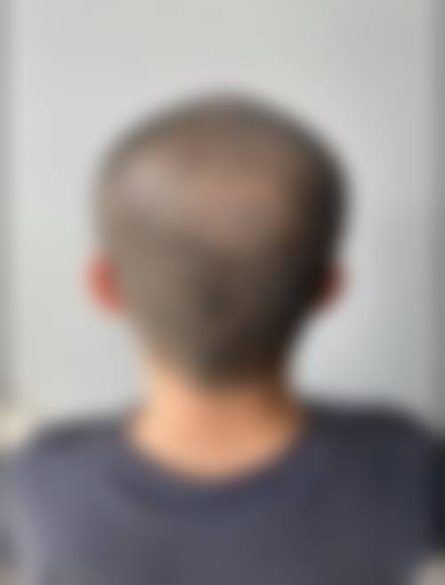 南宁雍禾植发医疗美容门诊部核心项目