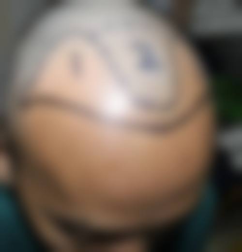 邯郸天画整形真实患者评价