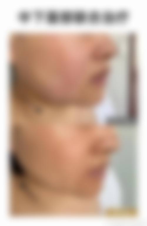 泉州泉港区卫生防疫站医学美容医院真实患者评价