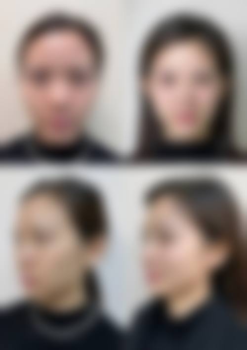 【东莞美诺德医疗美容诊所真实患者评价】