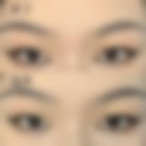 【东莞莞城曾学林整形医院真实患者评价】