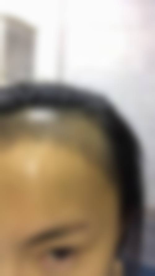 【成都艺美汇植发门诊部真实患者评价】