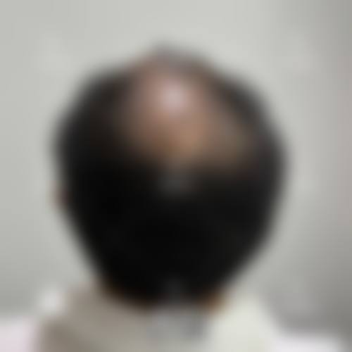 2026广东广州仁健植发价格表(仅供参考)