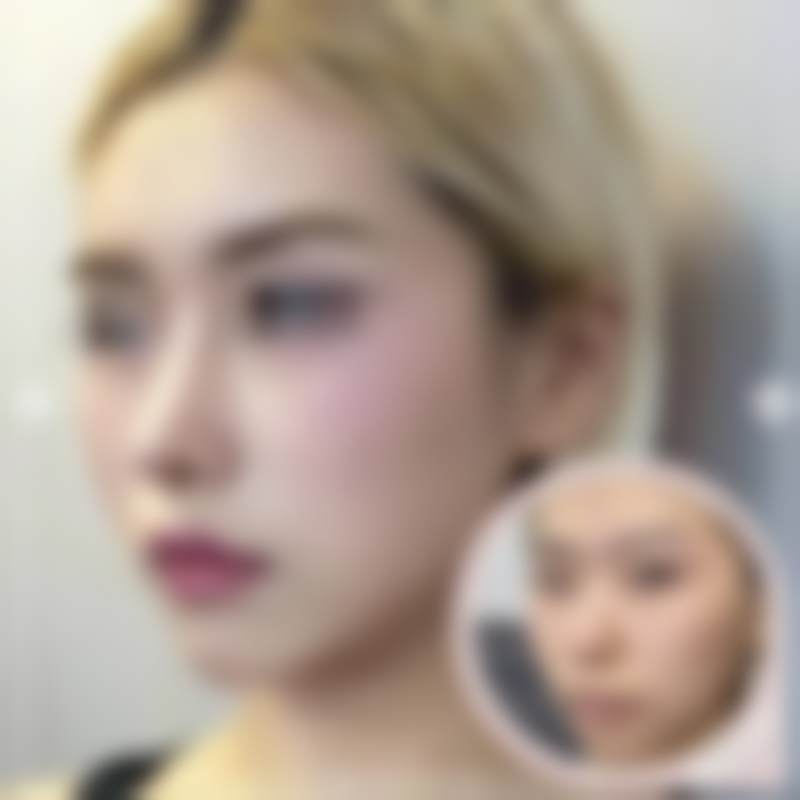 韩国优雅人朴哲佑做轮廓手术怎么样？解剖复位+微创隐蔽切口，下颌角/颧骨内推自然不僵硬