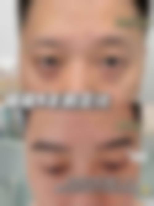 佛山大麦微针植发擅长项目