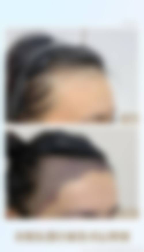 佛山大麦微针植发怎么预约?